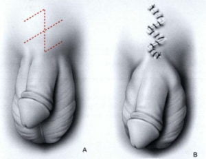 engrosamiento del pene colombia