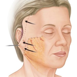 colombia lifting facial