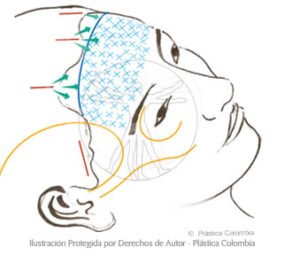estiramiento de la frente colombia