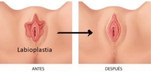 labioplastia colombia