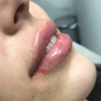 Aumento de labios relleno de labios colombia