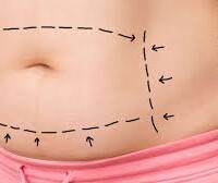Abdominoplastia abdominoplastia colombia